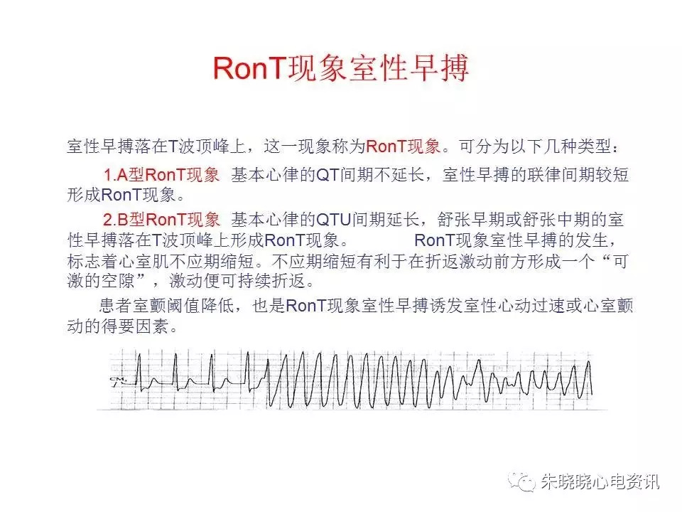 心电图危急值最全总结，赶快收藏备用！