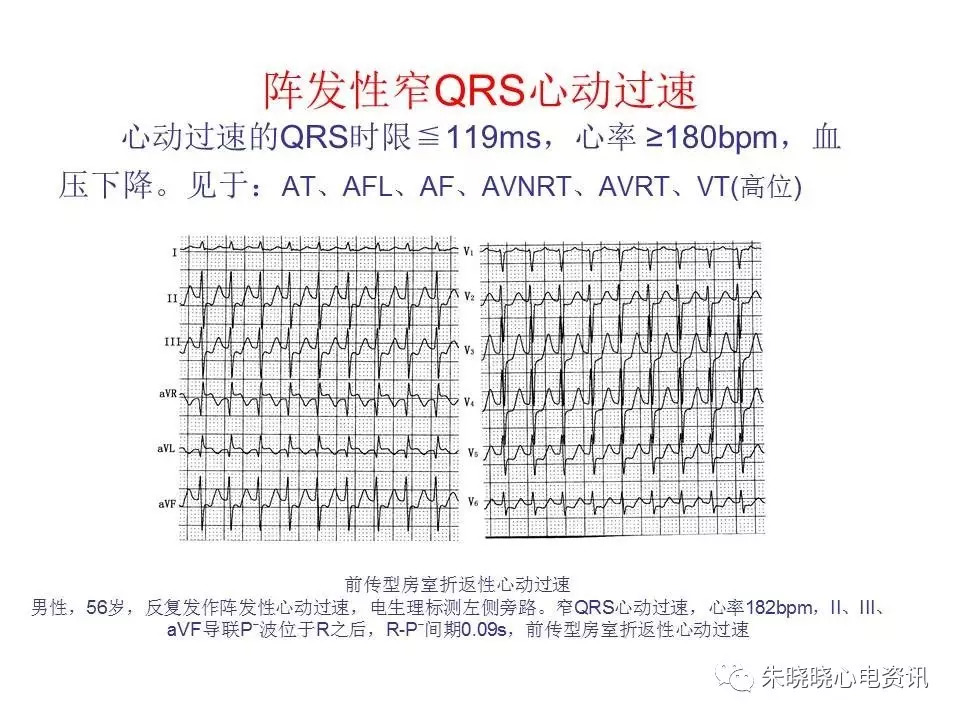 心电图危急值最全总结，赶快收藏备用！