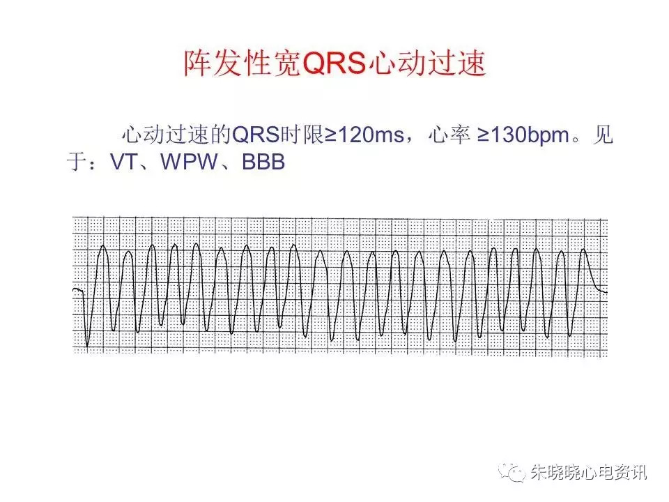 心电图危急值最全总结，赶快收藏备用！