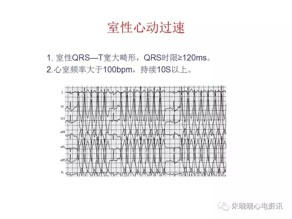 心电图危急值最全总结，赶快收藏备用！