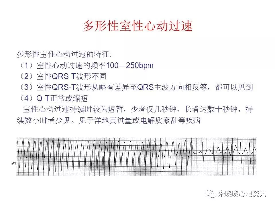 心电图危急值最全总结，赶快收藏备用！