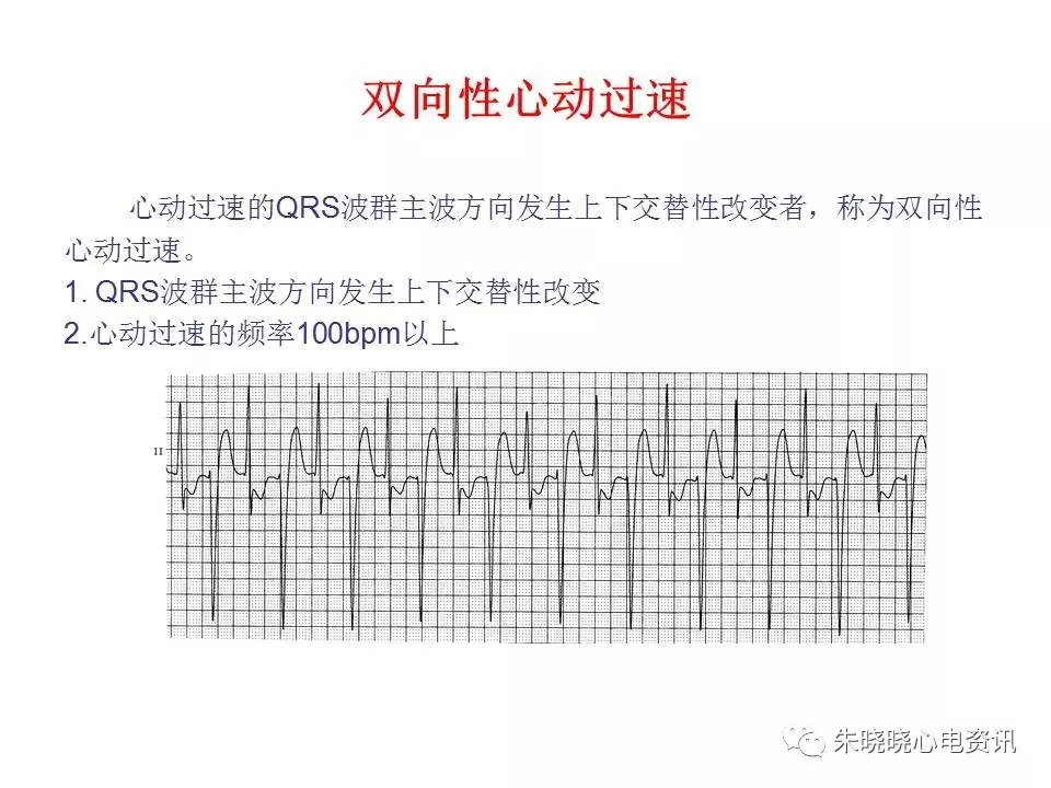 心电图危急值最全总结，赶快收藏备用！