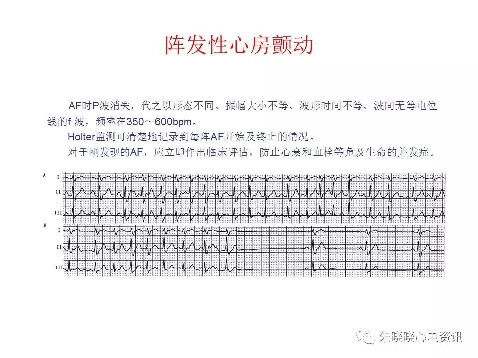 心电图危急值最全总结，赶快收藏备用！