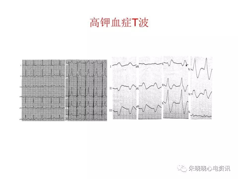 心电图危急值最全总结，赶快收藏备用！