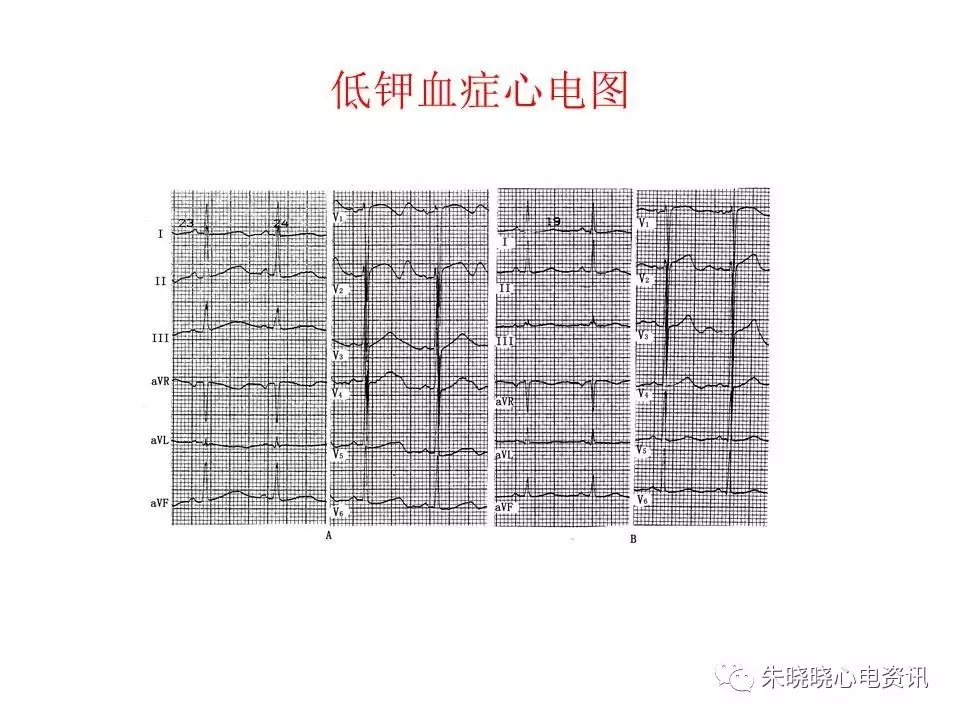 心电图危急值最全总结，赶快收藏备用！