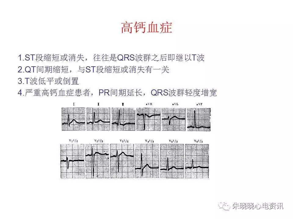 心电图危急值最全总结，赶快收藏备用！