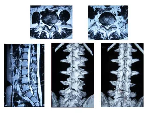 腰椎间盘突出症的分型及治疗策略