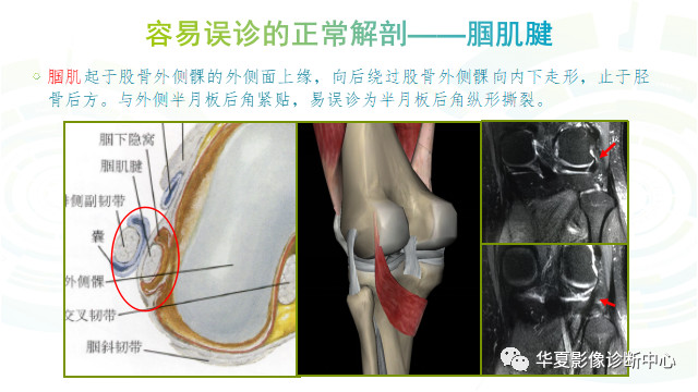 膝关节这些正常结构，您误诊了吗?