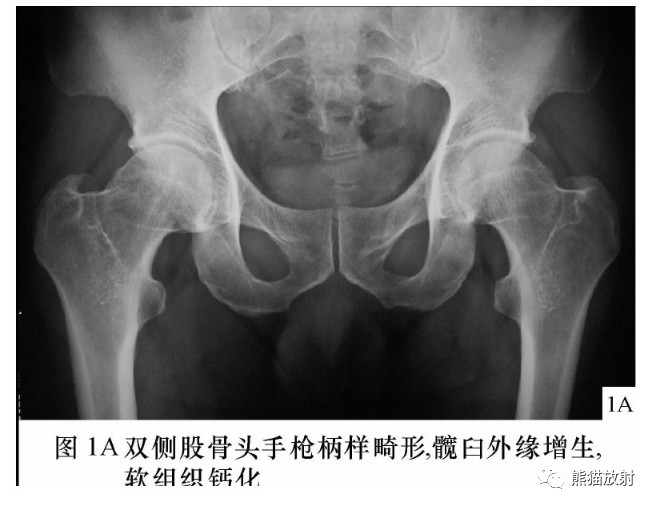 髋关节撞击综合征（FAI）的影像表现，系统详解！