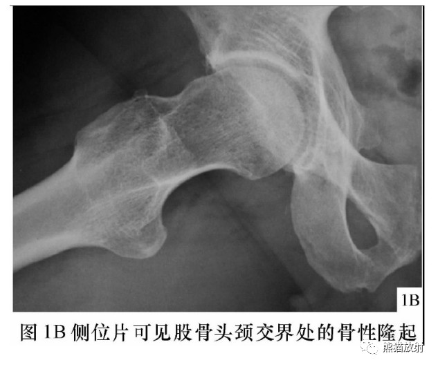 髋关节撞击综合征（FAI）的影像表现，系统详解！