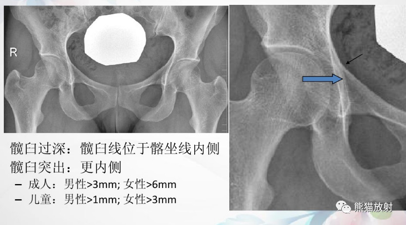 髋关节撞击综合征（FAI）的影像表现，系统详解！