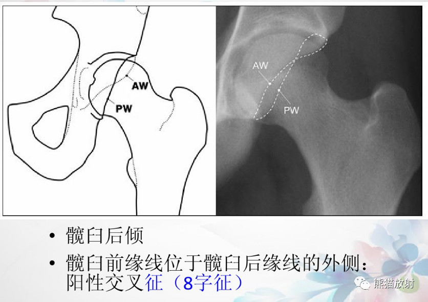 髋关节撞击综合征（FAI）的影像表现，系统详解！