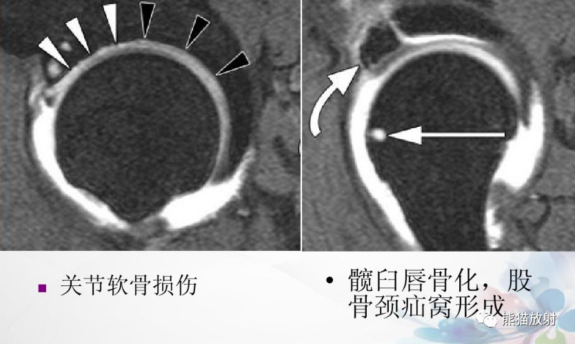 髋关节撞击综合征（FAI）的影像表现，系统详解！