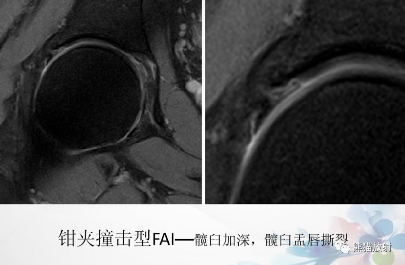 髋关节撞击综合征（FAI）的影像表现，系统详解！