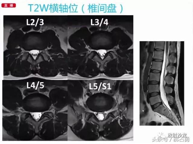 几张图教你看懂腰椎间盘MRI影像