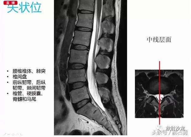 几张图教你看懂腰椎间盘MRI影像