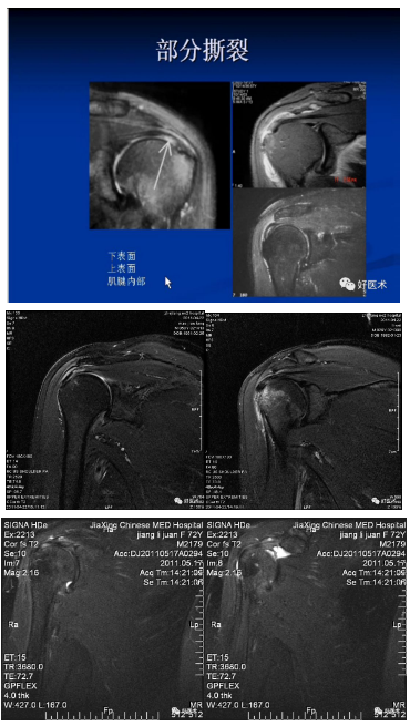 肩袖损伤核磁共振图片图片