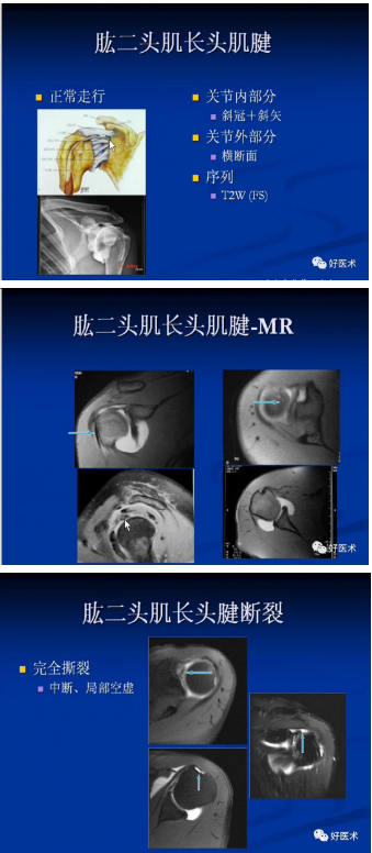 肩袖解剖mr图片