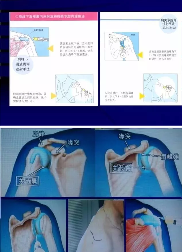 各关节腔穿刺方法技巧大全，太详细了！