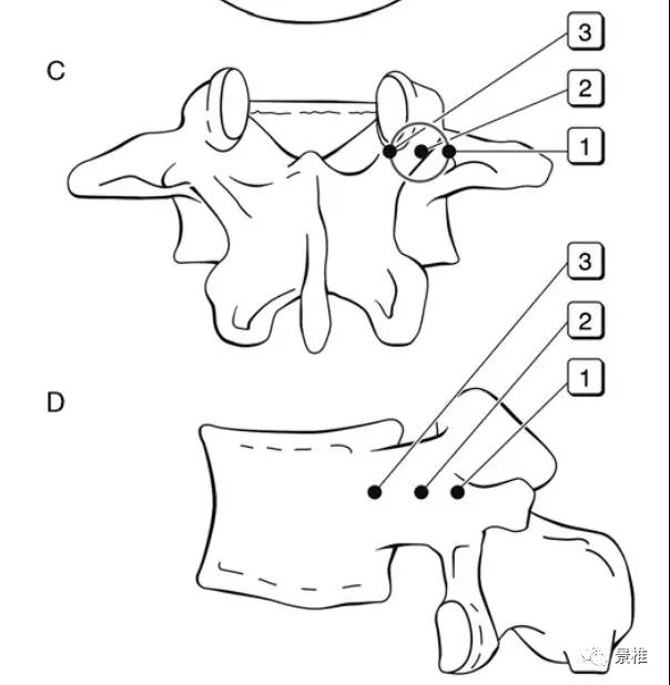经皮椎弓根穿刺技术要点，一图明了！