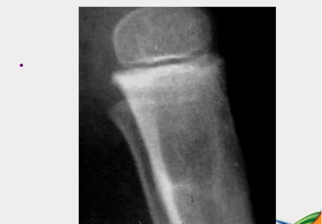 应力性骨折影像学诊断，看这篇就够了！