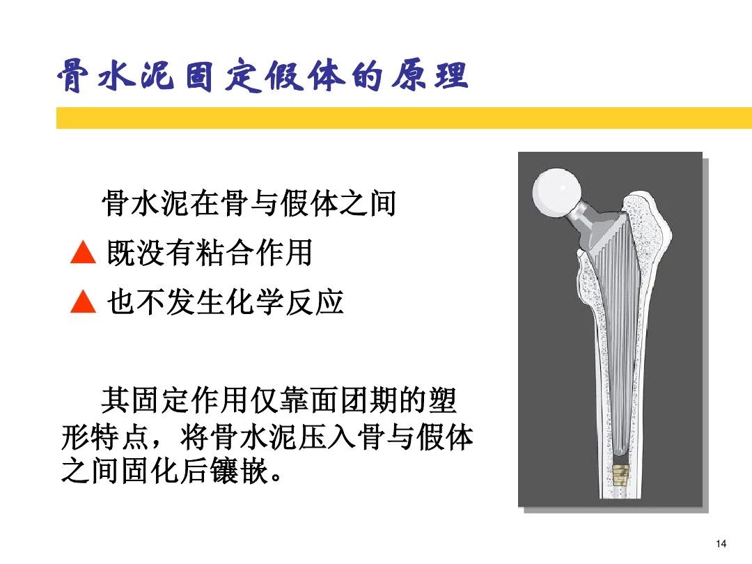 干货！全方位讲解骨水泥的应用和技巧！