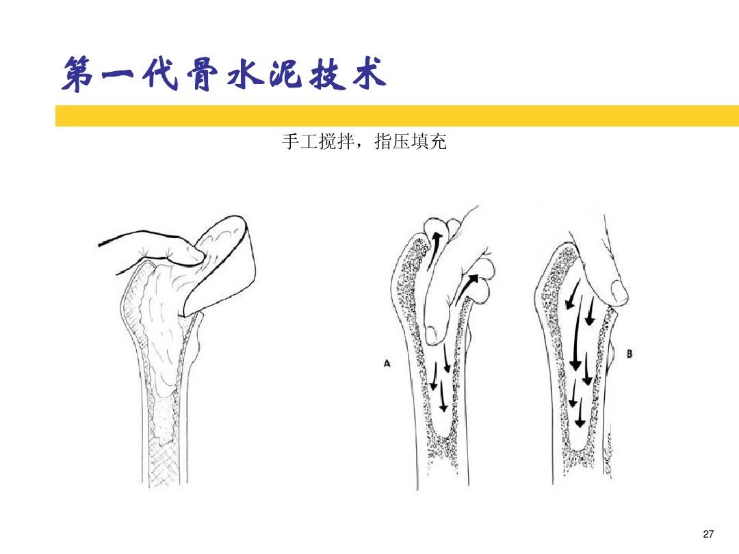 干货！全方位讲解骨水泥的应用和技巧！