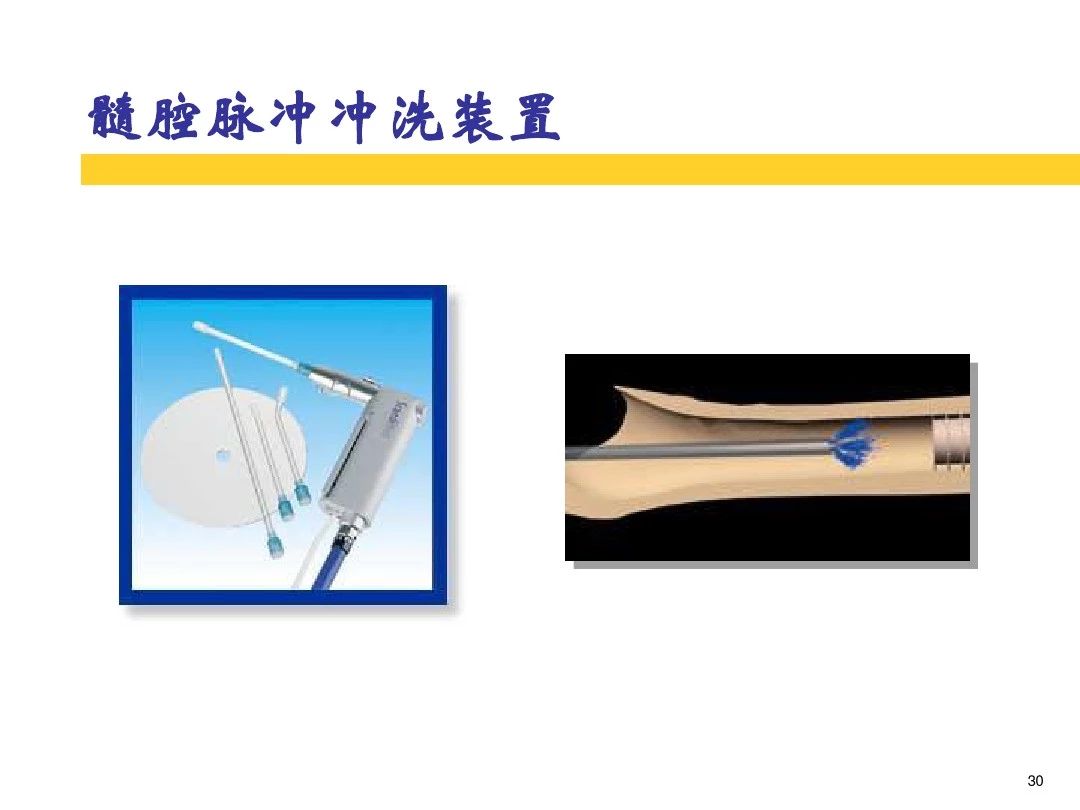 干货！全方位讲解骨水泥的应用和技巧！