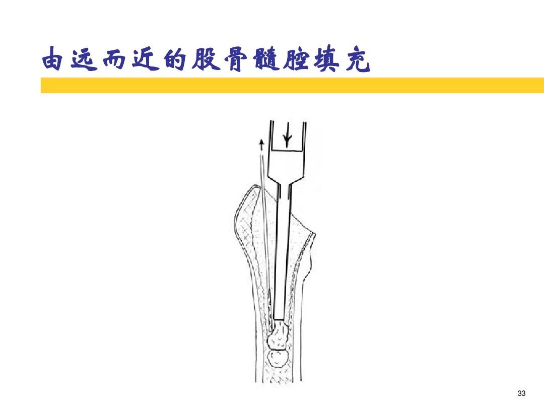 干货！全方位讲解骨水泥的应用和技巧！