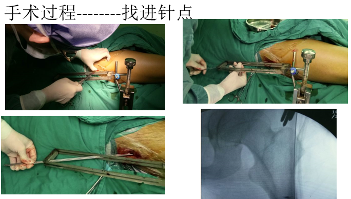 一篇掌握：股骨骨折闭合复位髓内钉固定术！