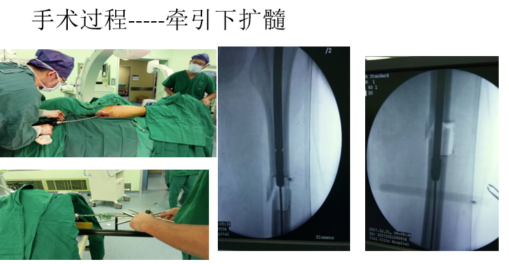 一篇掌握：股骨骨折闭合复位髓内钉固定术！