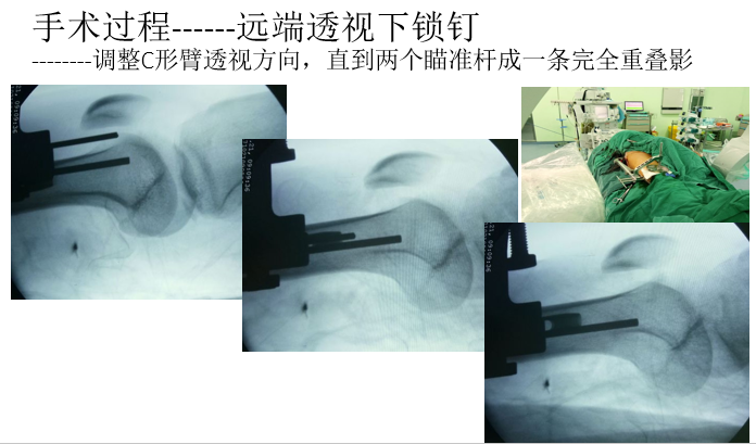 一篇掌握：股骨骨折闭合复位髓内钉固定术！