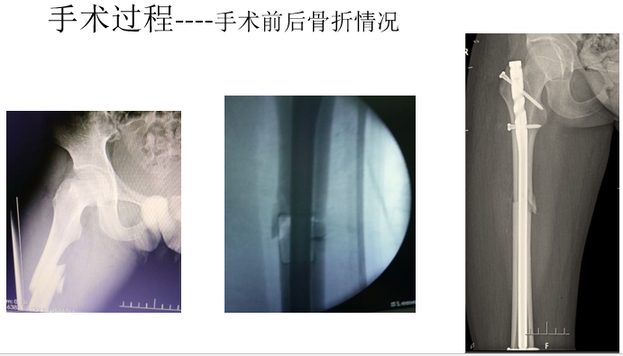 一篇掌握：股骨骨折闭合复位髓内钉固定术！