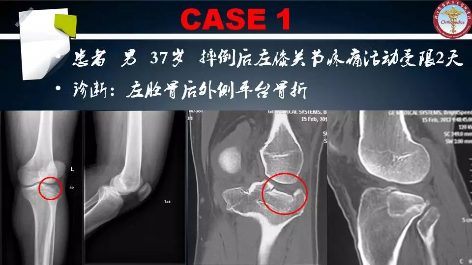 腓骨头截骨入路治疗胫骨后外侧平台骨折