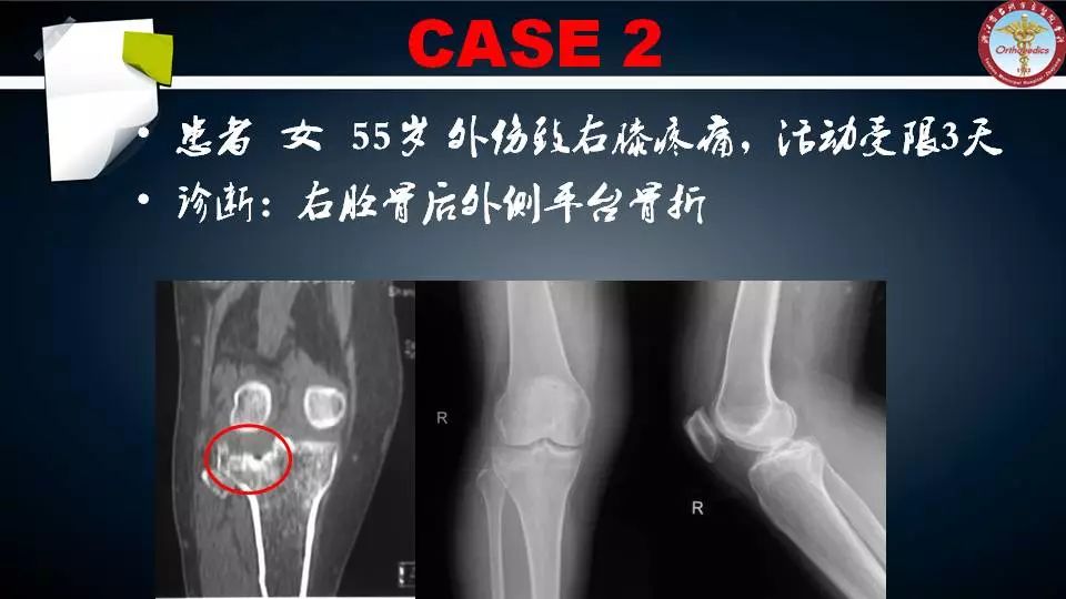 腓骨头截骨入路治疗胫骨后外侧平台骨折