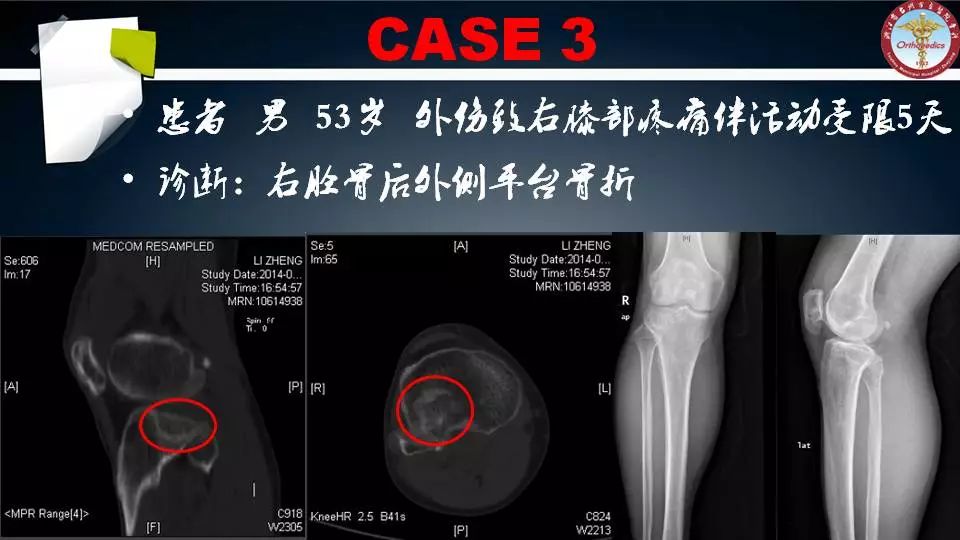 腓骨头截骨入路治疗胫骨后外侧平台骨折