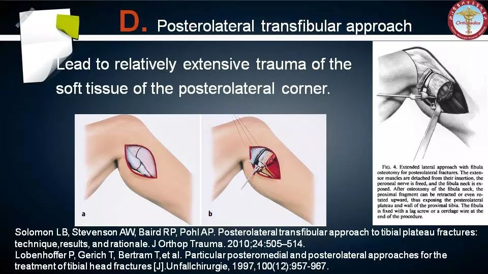 腓骨头截骨入路治疗胫骨后外侧平台骨折