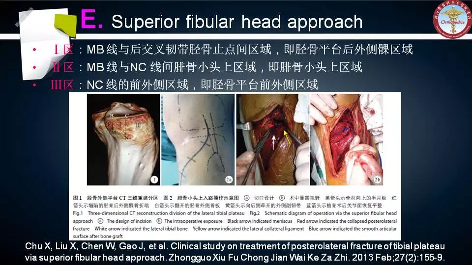 腓骨头截骨入路治疗胫骨后外侧平台骨折