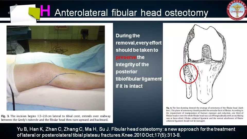 腓骨头截骨入路治疗胫骨后外侧平台骨折