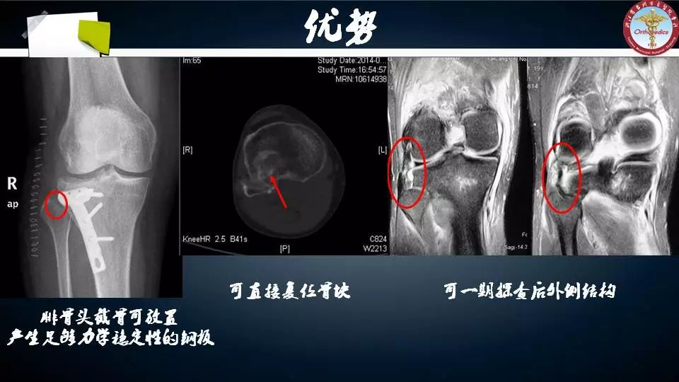 腓骨头截骨入路治疗胫骨后外侧平台骨折