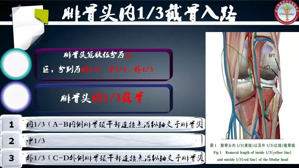 腓骨头截骨入路治疗胫骨后外侧平台骨折