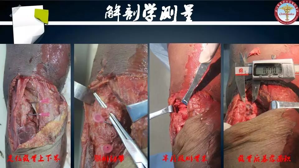 腓骨头截骨入路治疗胫骨后外侧平台骨折