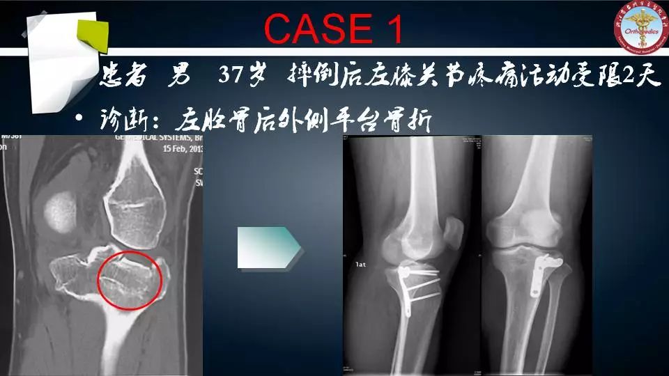 腓骨头截骨入路治疗胫骨后外侧平台骨折