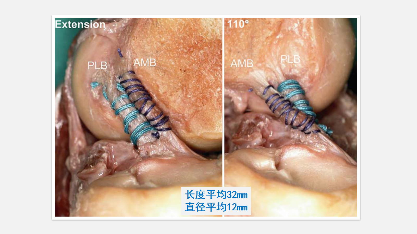 前交叉韧带（ACL）损伤的MRI诊断技巧，详细解析！