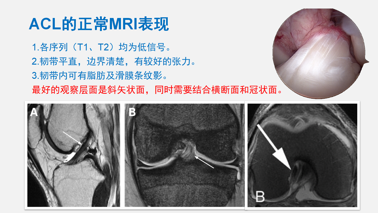 前交叉韧带（ACL）损伤的MRI诊断技巧，详细解析！