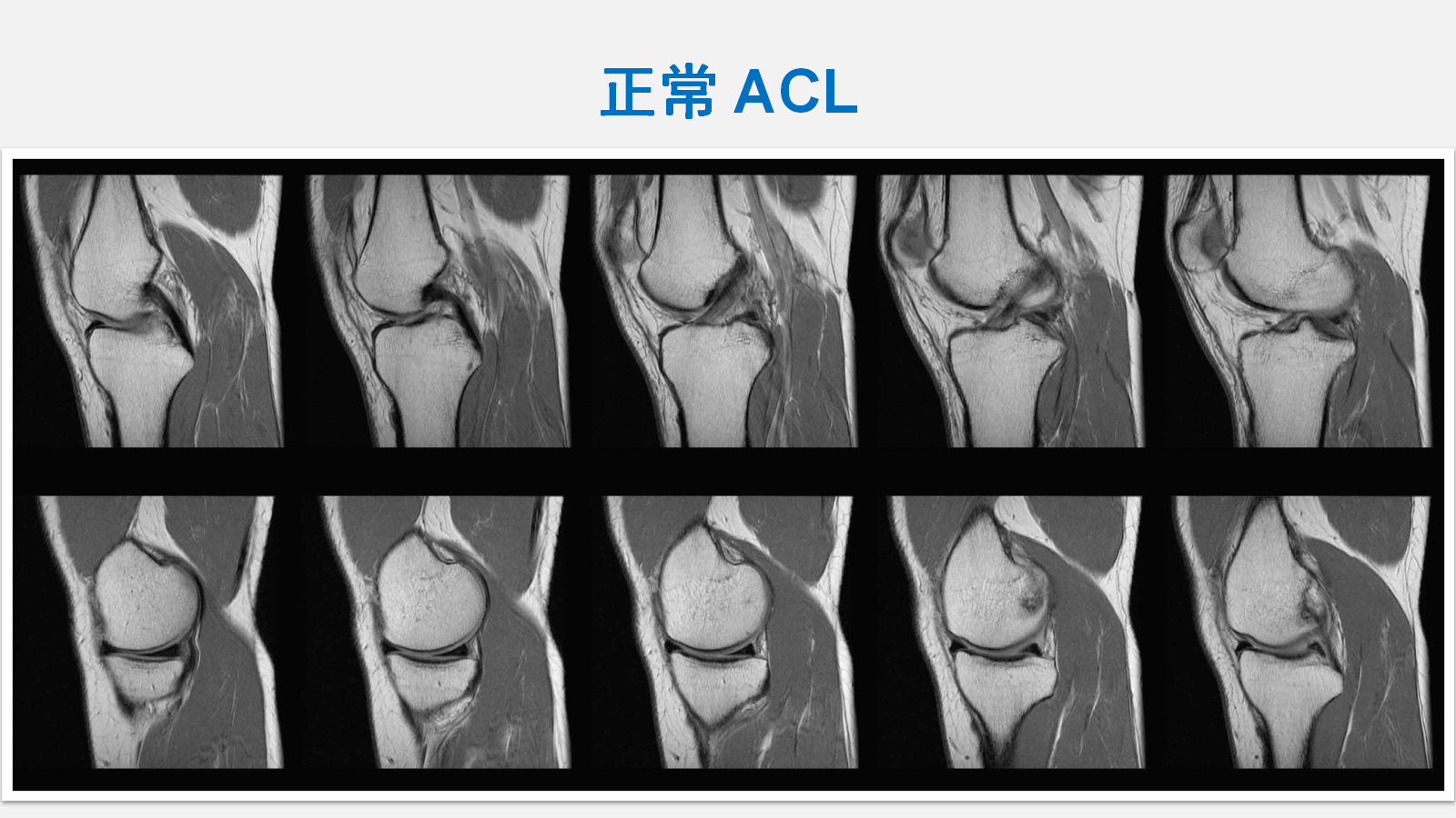 前交叉韧带（ACL）损伤的MRI诊断技巧，详细解析！