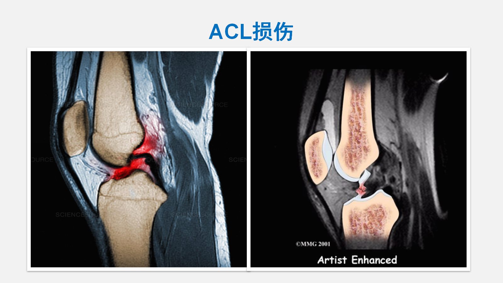 前交叉韧带（ACL）损伤的MRI诊断技巧，详细解析！