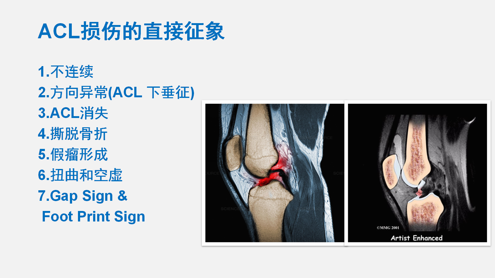 前交叉韧带（ACL）损伤的MRI诊断技巧，详细解析！