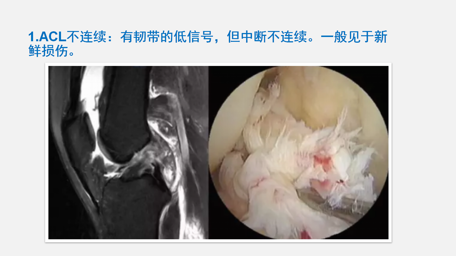 前交叉韧带（ACL）损伤的MRI诊断技巧，详细解析！