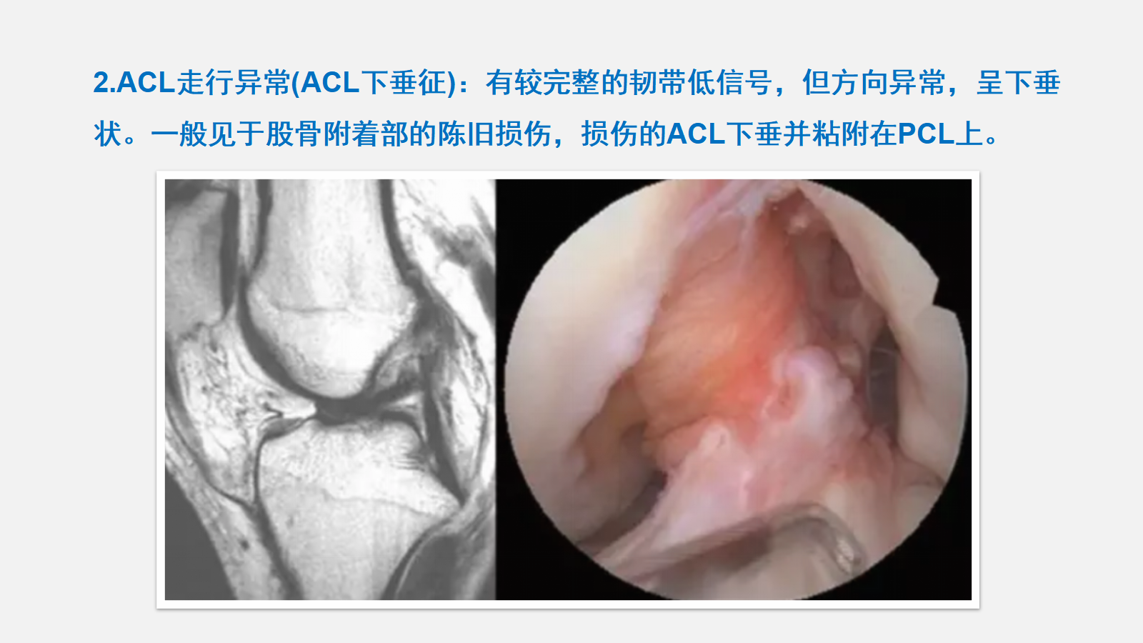 前交叉韧带（ACL）损伤的MRI诊断技巧，详细解析！